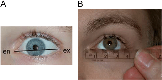 Palpebral fissure length PFL Distance between the endocanthion and exocanthion