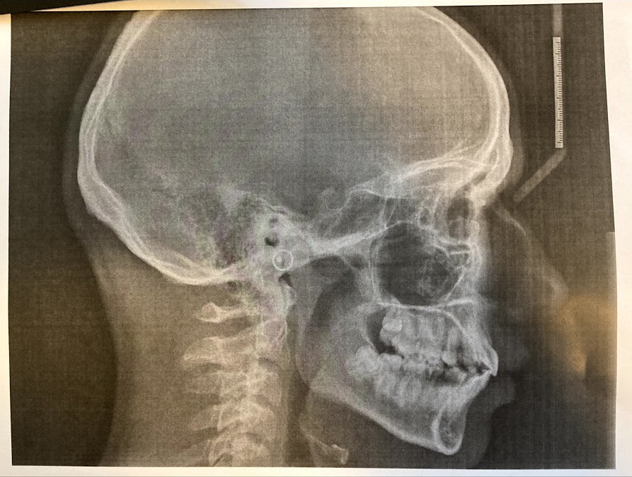 After xray