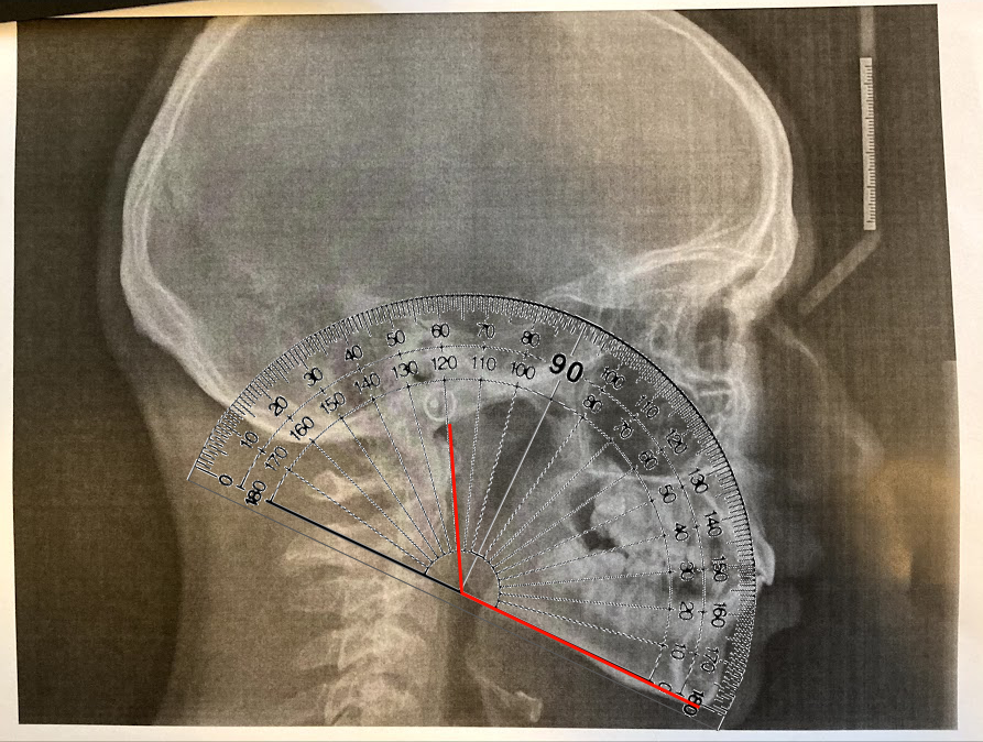 After xray gonial
