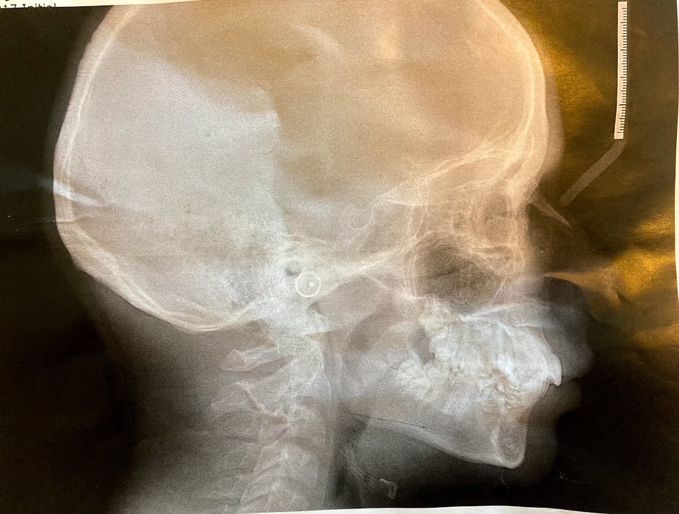 Before xray
