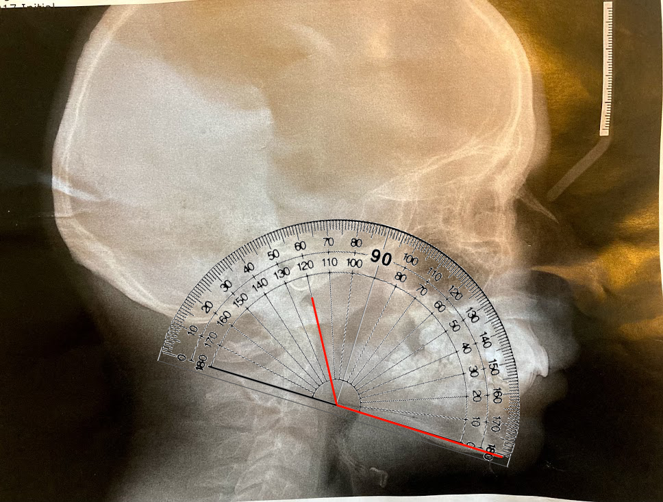 Before xray gonial