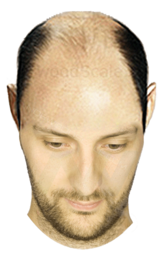 Norwood Scale 6 Example 352x550