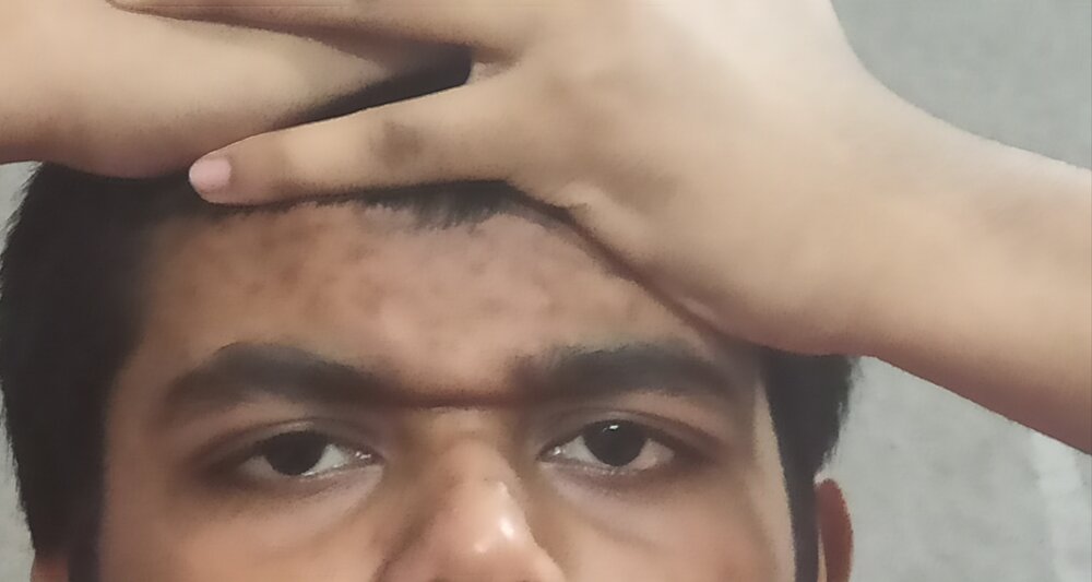 Pushing my head skin down