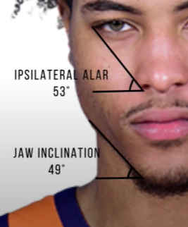 Ipsilateralalar