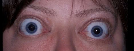 Bulgingeyes e1402753263551