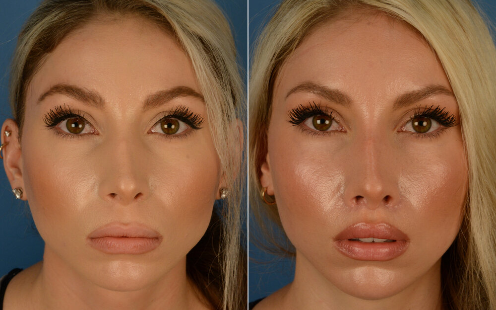 Lip lift before after