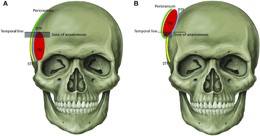 The chimeric reverse temporal muscle and pericranial flap A Anatomic relation of the