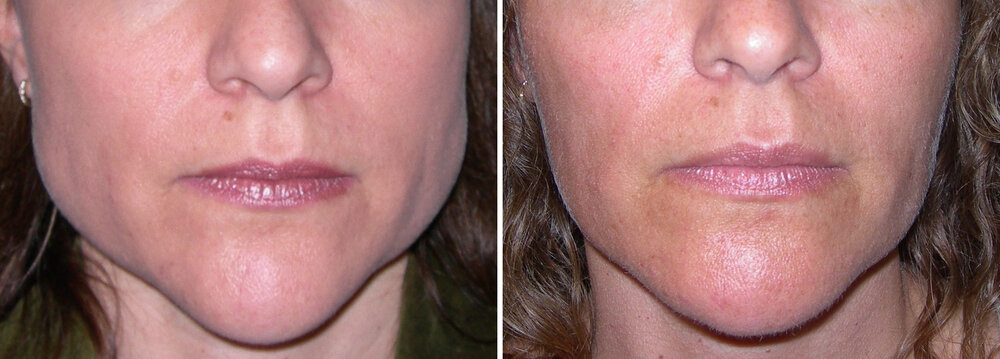 Masseter Hypertroph Looks Insane Looksmax Men s Self 