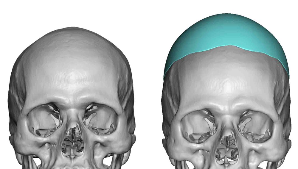 Custom Skull Heightneing Implant design front view Dr Barry Eppley Indianapolis