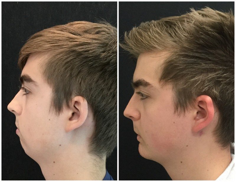 Chin implant 8