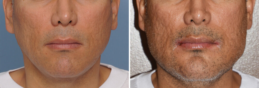 Custom Jawline Implant Replacement of Medpor Implant result front view Dr Barry Eppley Indiana