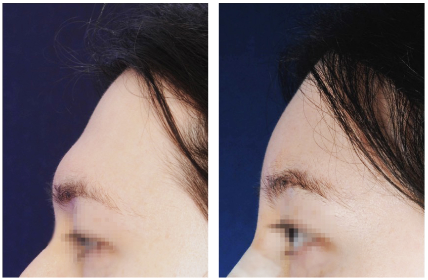 Brow bone reduction type 4 before and after