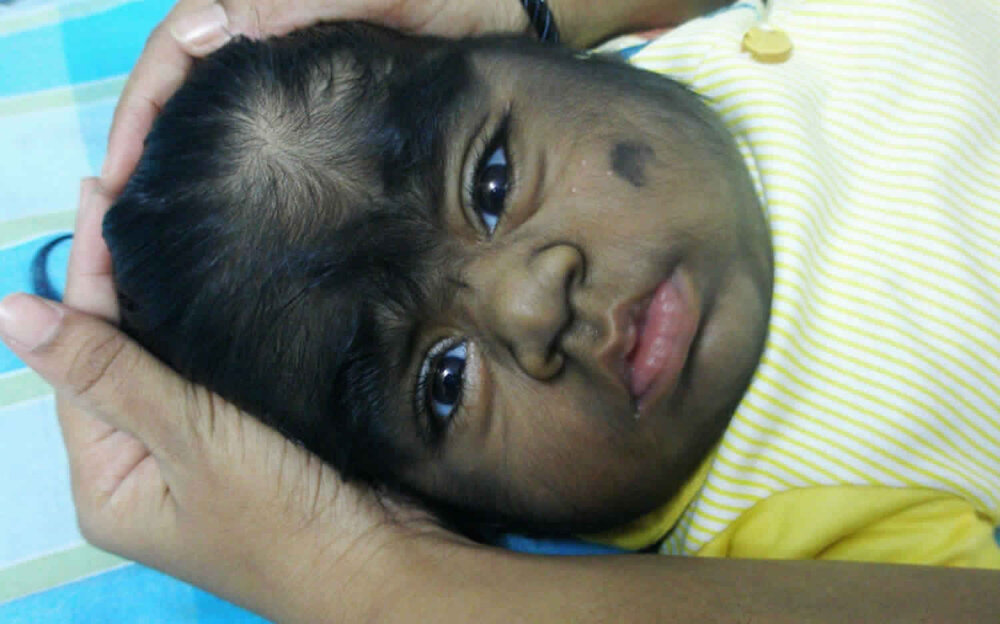 Hypertrichosis