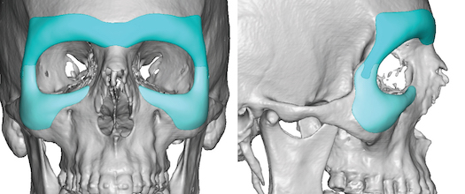 Two Piece Interlocking Custom Eyemask Implant design Dr Barry Eppley Indianapolis 1