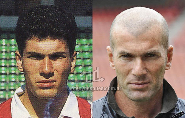Zinedine Zidane hair pelado antesydespuescomar