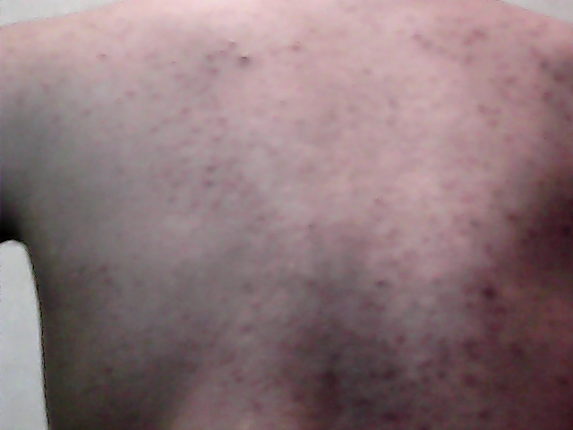 Versicolor9