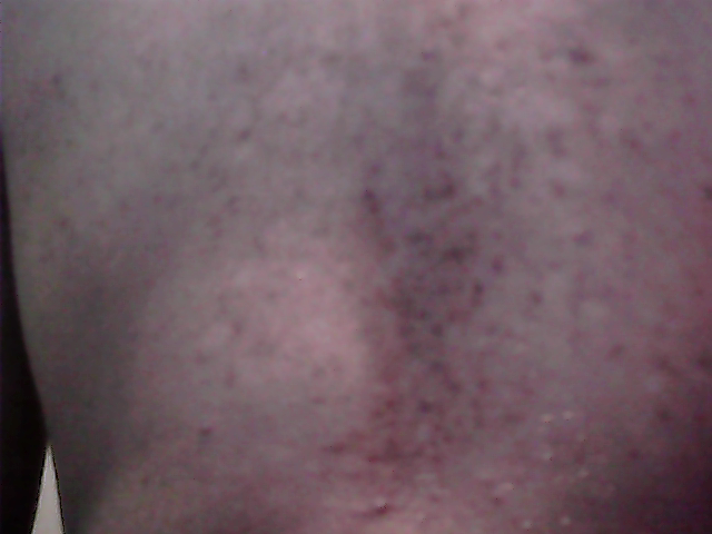 Versicolor5