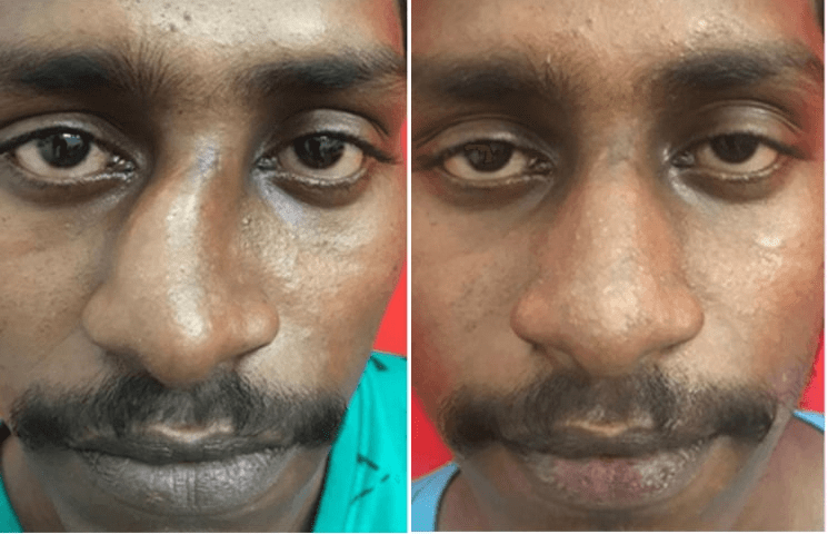 Before after cleft lip rhinoplasty in india