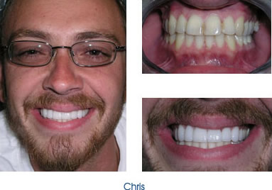 Spaces close with veneers 10