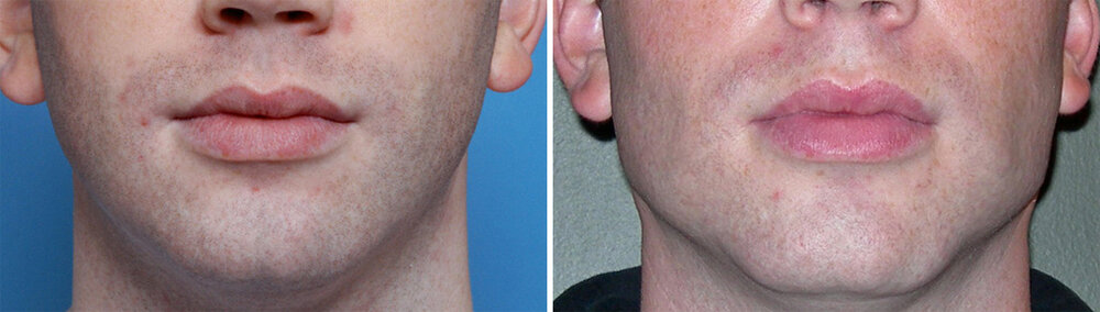 Standard Chin and Jaw Angle Implants result front view Dr Barry Eppley Indianapolis