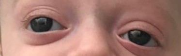 Baby with Crouzon Syndrome2