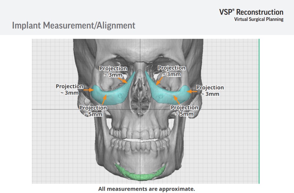 Implant design
