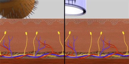 Dermapen versus dermaroller