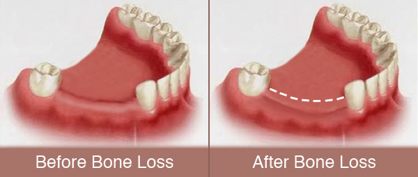 Bone loss