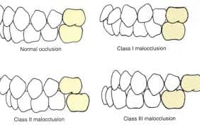 Malocclusions