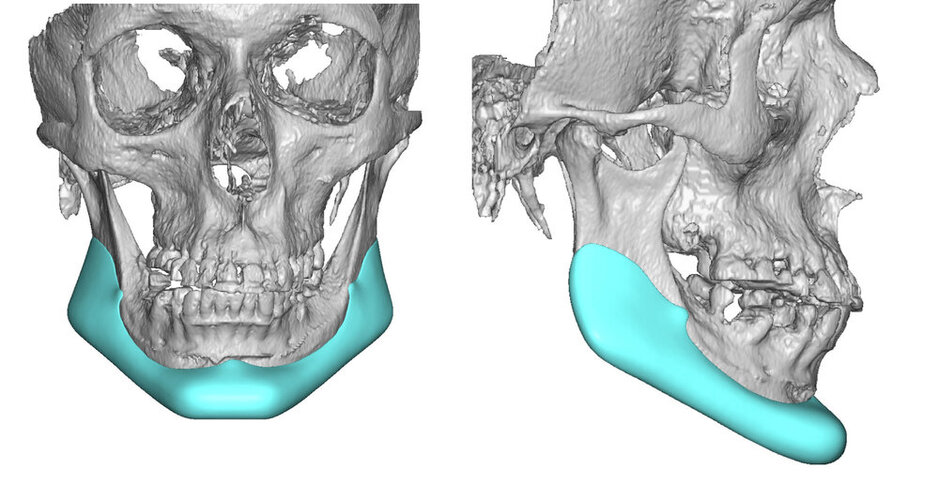 Custom-Jawline-Implant-design-to-replace-a-prior-chin-implant-Dr-Barry-Eppley-Indianapolis.jpg