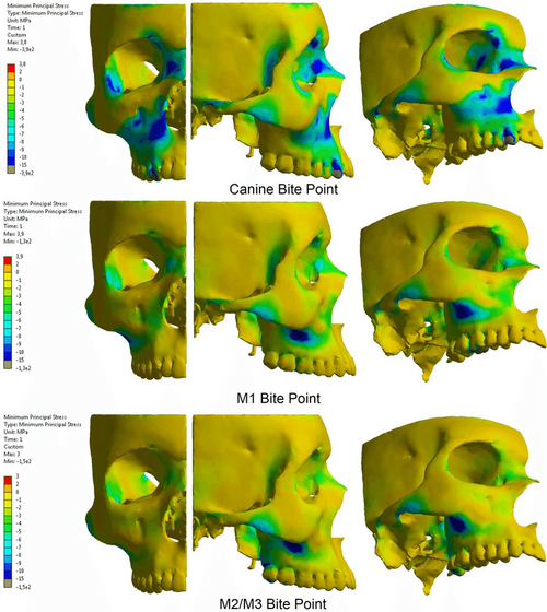 Minimum principal compressive stress distribution in the human facial skeleton during Minimum principal compressive stress distribution in the human facial skeleton during