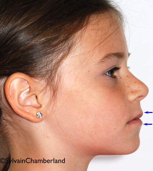 MaLaBe vue profil post traiitement masque facial 29092011 Orthodontiste Chamberland Quebec