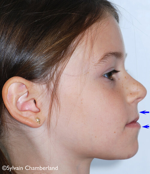MaLaBe classe III profil 07102010 Orthodontiste Chamberland Quebec