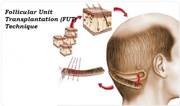 FUT hair transplant Iran