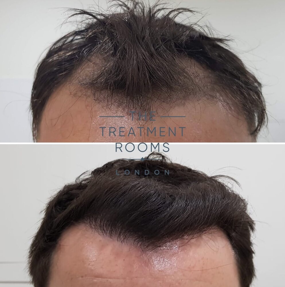 Frontal Hairline Hair Transplant