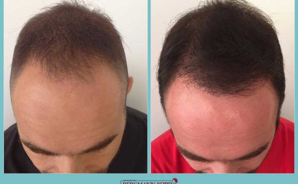 Metamosxefsi malliwn fue hair clinic apotelesmata prin meta genika 32081PG 001 600x370