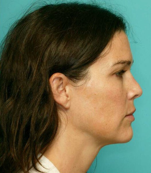 Mewingbeforeafter2
