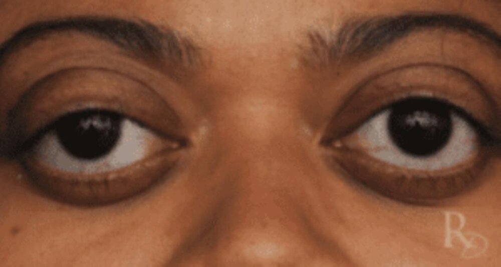 116202050636 23041q5ddx bulging eye 3