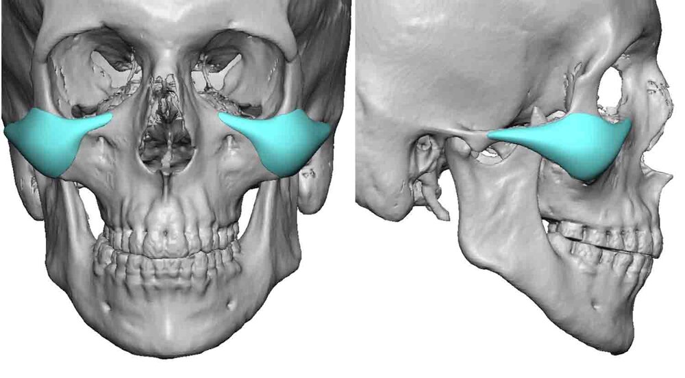 Malar Arch Cheek Implant Desigtn Dr Barry Eppley Indianapolis