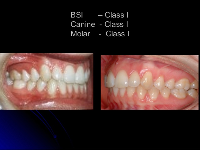 Classification of normal occlusion and malocclusion 6 638