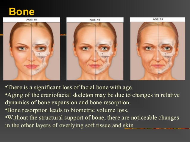 BoneLossFace