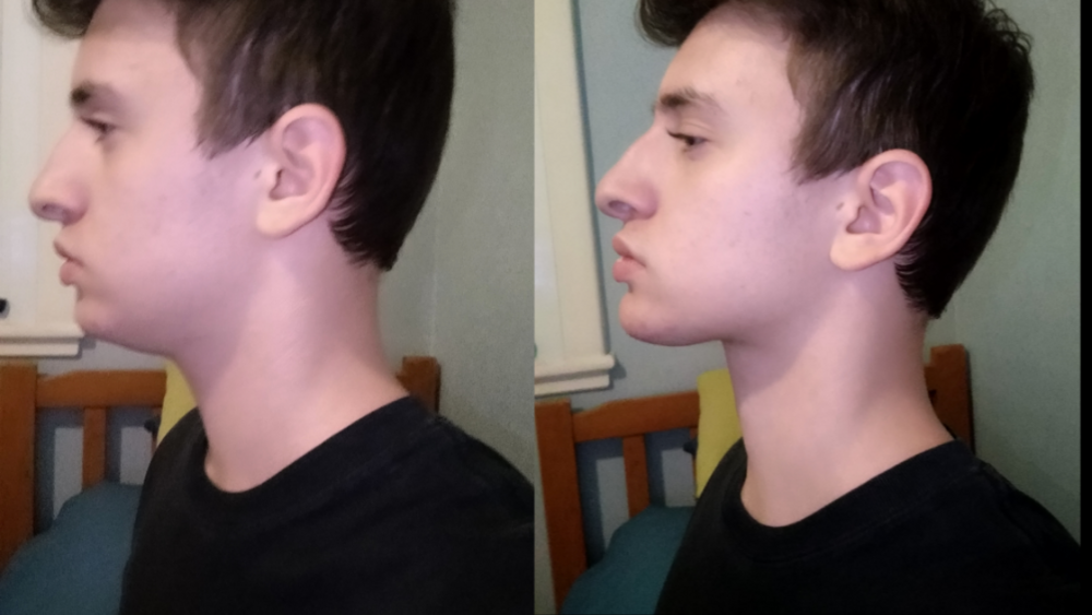 Mewing and teeth pain Delivery 1