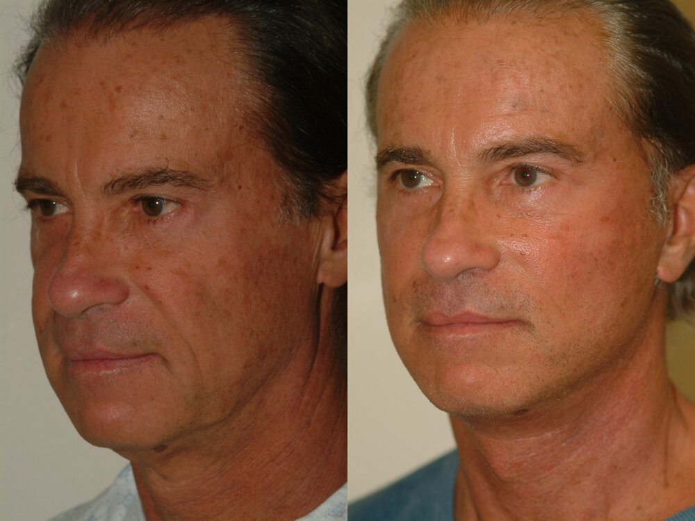 Male facelift 3b