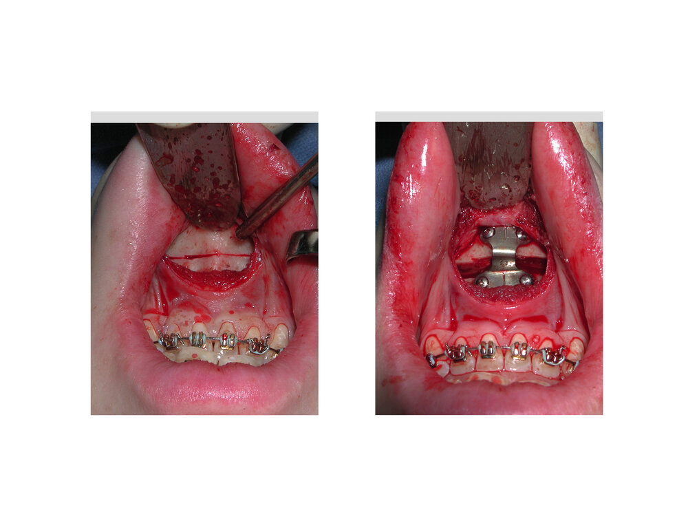 Sliding Geniopasty intraop technique Dr Barry Eppley Indianapolis