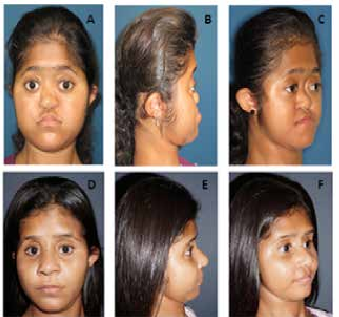Facial characteristics before A B C and after D E F surgery Le Fort III advancement