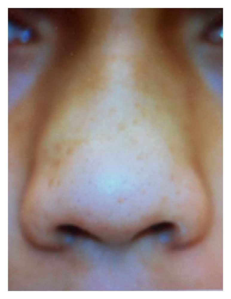 A Frontal view of the external nose Note the swelling of the lateral walls b A CT