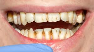 Image result for disgusting teeth