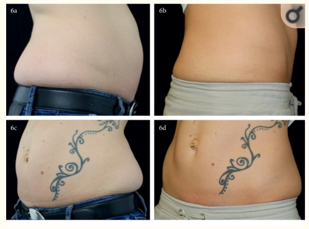 Before after Before after