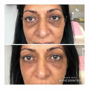 Improve under eye darkness 300x300