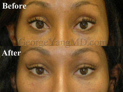 Before and after Restylane Upper eyelid 003WM